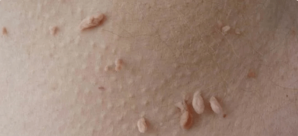 HPV-ren transmisio metodoa