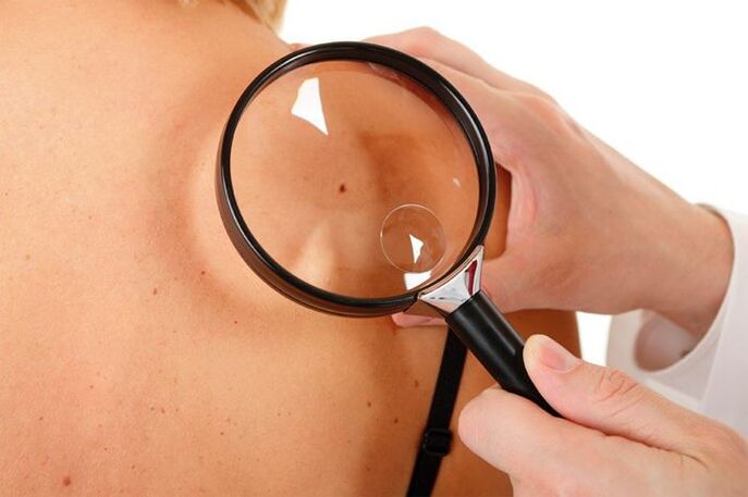 HPV duen gaixo baten azterketa