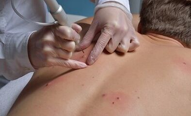 papilomak kentzeko moduak