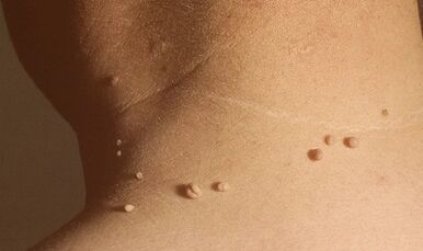 papilomaren arrazoiak