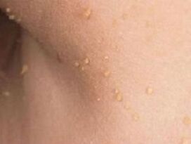 gorputzean papilomak agertzearen arrazoiak