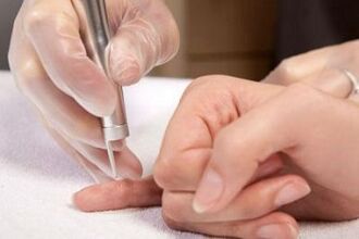 nola kentzeko papilomak gorputzean