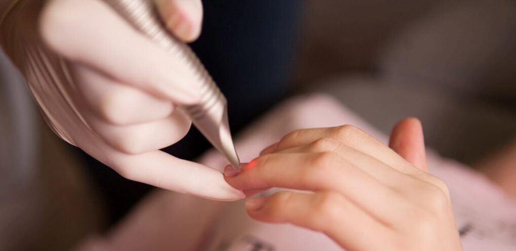 garatxoen laser tratamendua